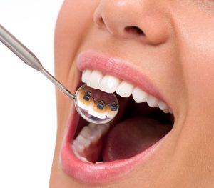 The Latest High-Tech Braces Options Available Today