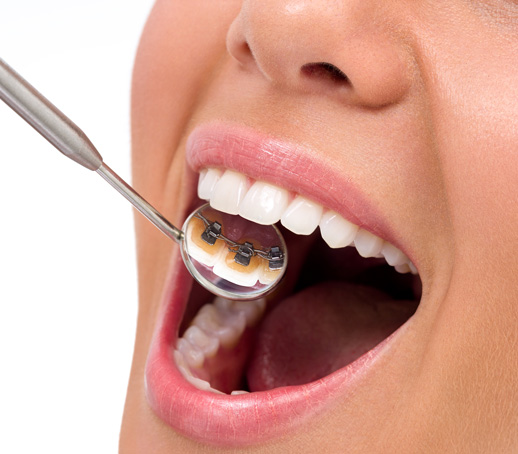 The Latest High-Tech Braces Options Available Today